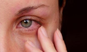 حرقان العين لأكثر من 3 أيام يستدعي استشارة الطبيب