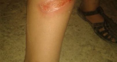 بواسطة سكين محمّى على النار.. حرق جسد ابنته امتعاضاً من ضجيجها!