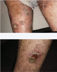 “جَرَب” في سجن رومية!