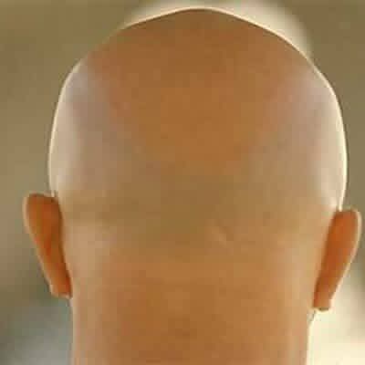 الرجل الأصلع سيتمكن من توليد الكهرباء من خلال صلعته