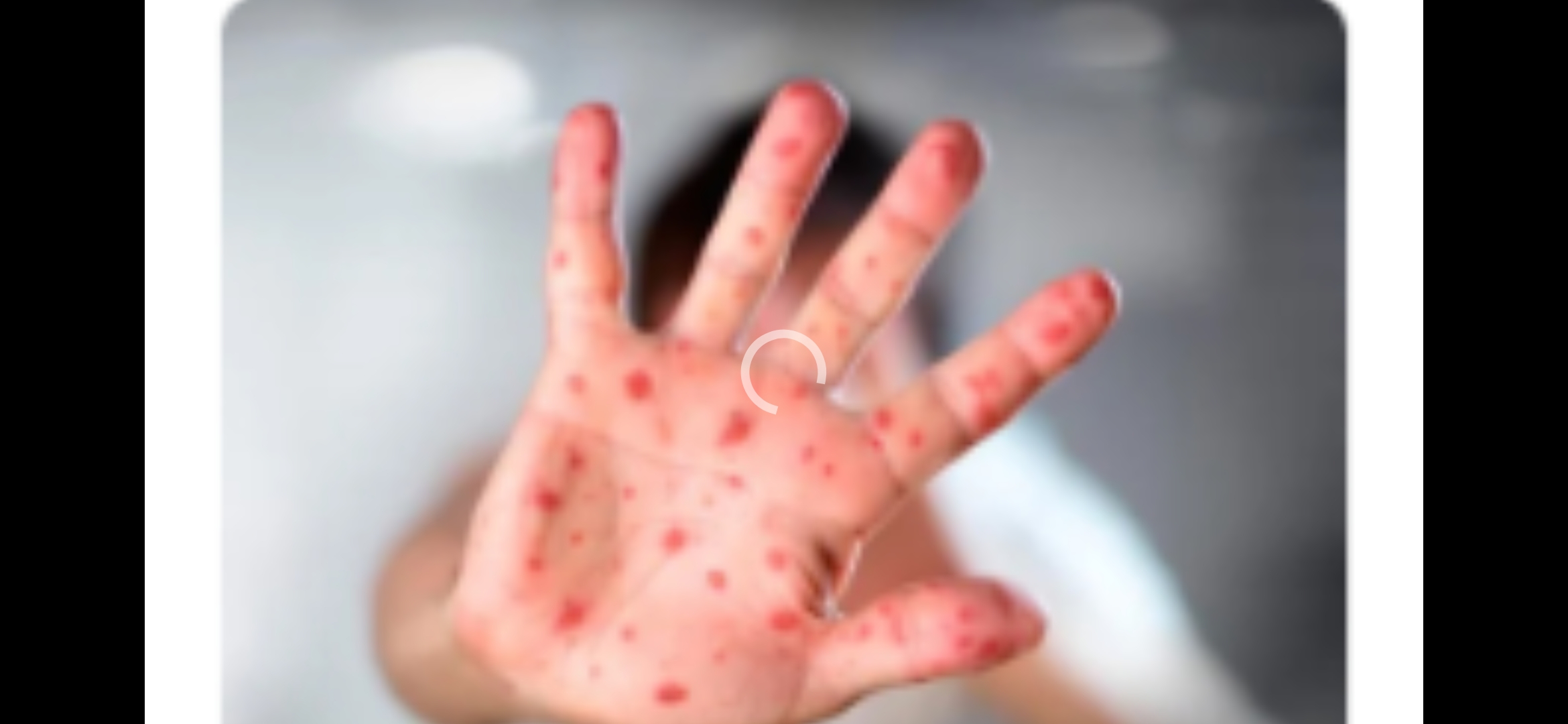 التفتيش المركزي يفتح تحقيقًا حول انتشار الحمى القلاعية