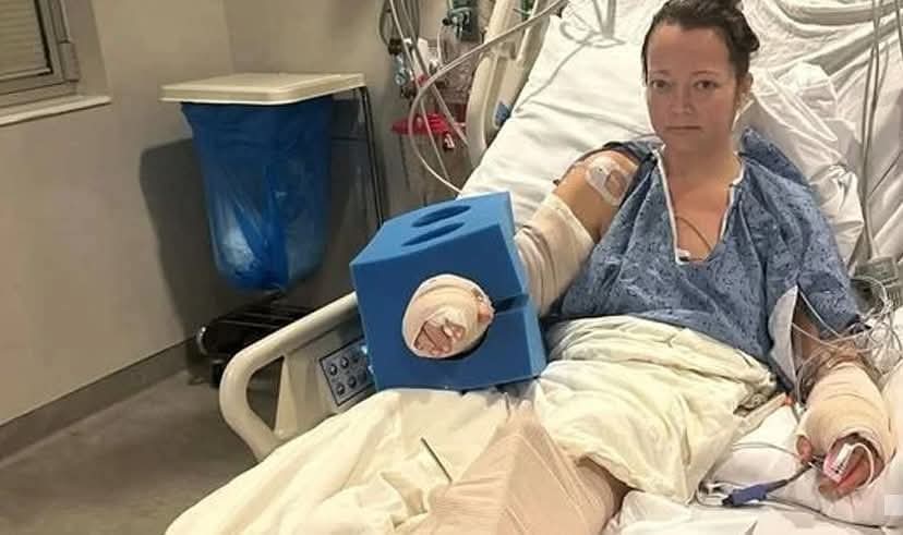 هجوم عنيف من كلبها أدى بتر ساقها 