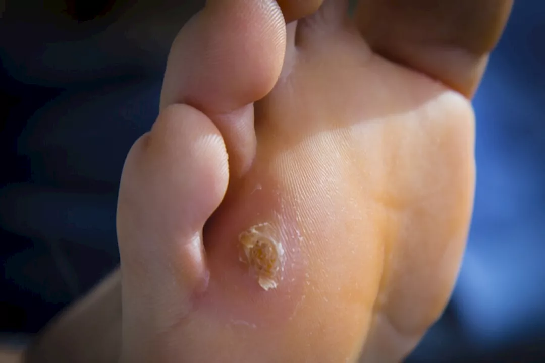 هذه أسباب ظهور مسامير القدم.. إليك نصائح للوقاية منها
