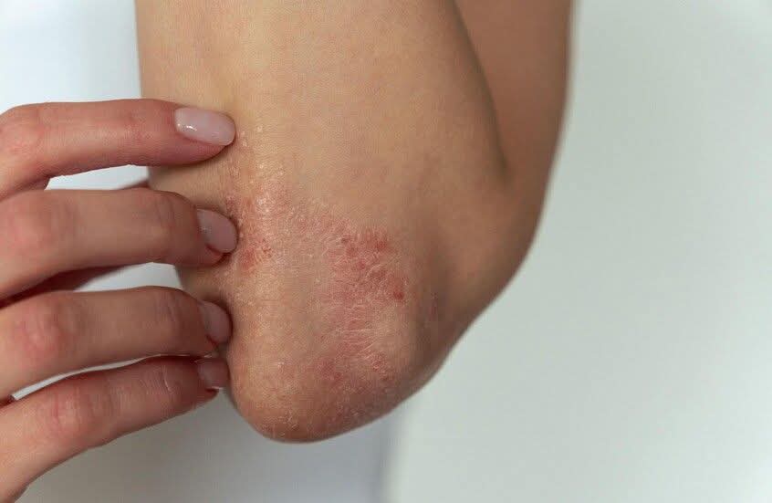 هل يمكن لمرض جلدي أن يدمّر نومك وذاكرتك