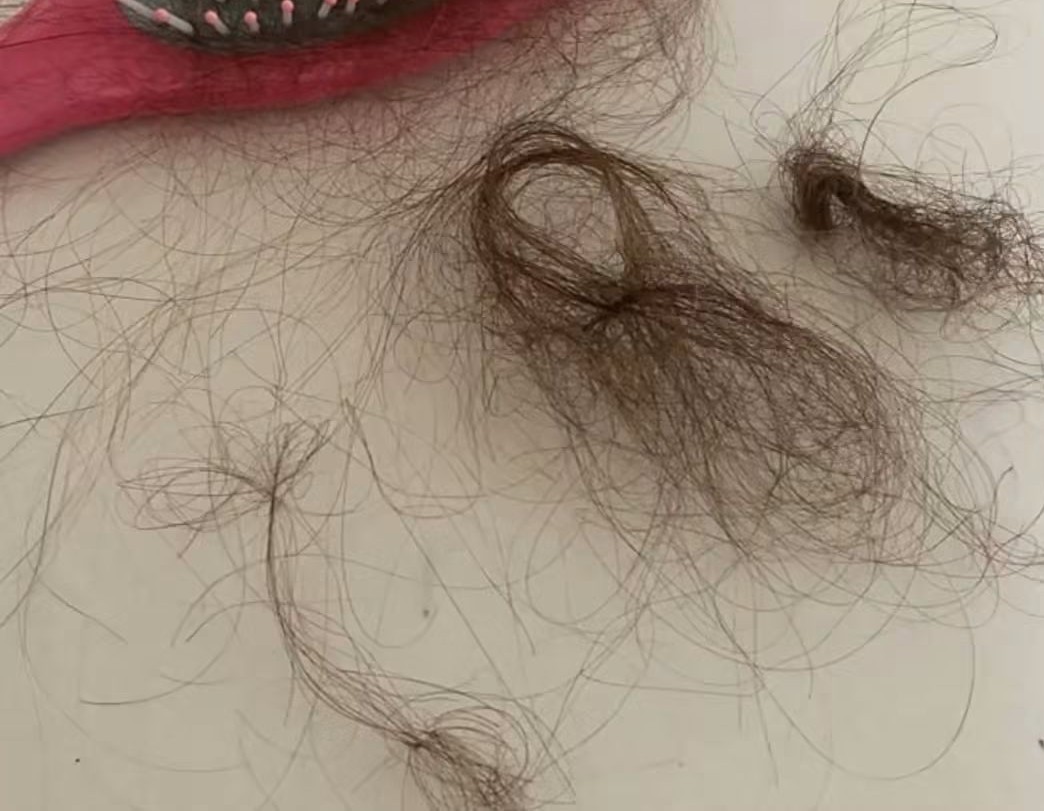تساقط الشعر.. متى يكون طبيعياً ومتى يستدعي الانتباه؟